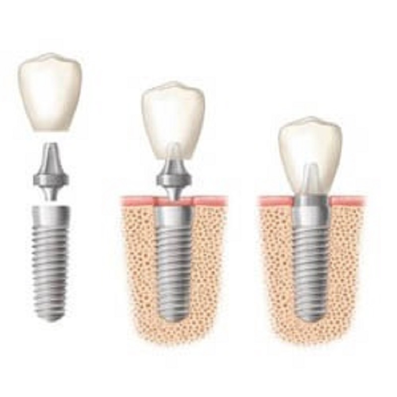 DENTAL IMPLANT PROFESSIONALS Sydney