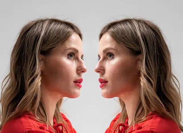 Rhinoplasty Surgery in Delhi - Dr Rajat Gupta
