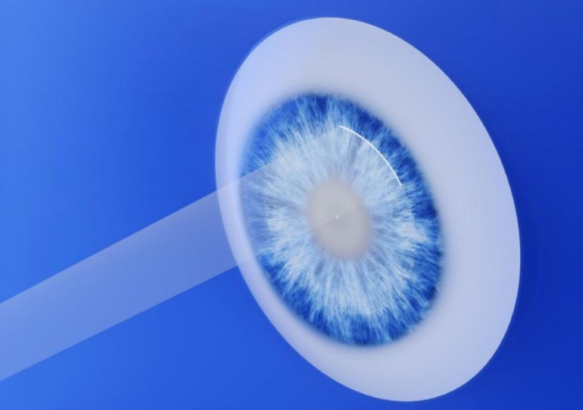 Laser Vision SA - SMILE Laser Eye Surgery - Gallery 1