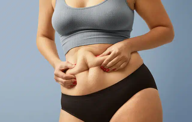 Tummy Tuck Surgery in Delhi - Dr Rajat Gupta - Gallery 1