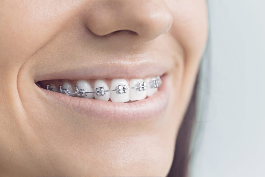 Beyond Braces - Gallery 2