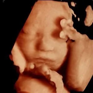 Tummy Vision 3D/4D Ultrasound & Gender Reveal - Gallery 2