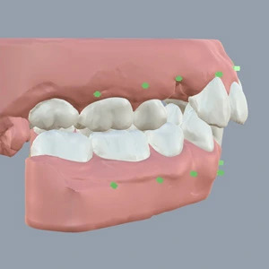 Kristelle Klear Aligners - Gallery 1